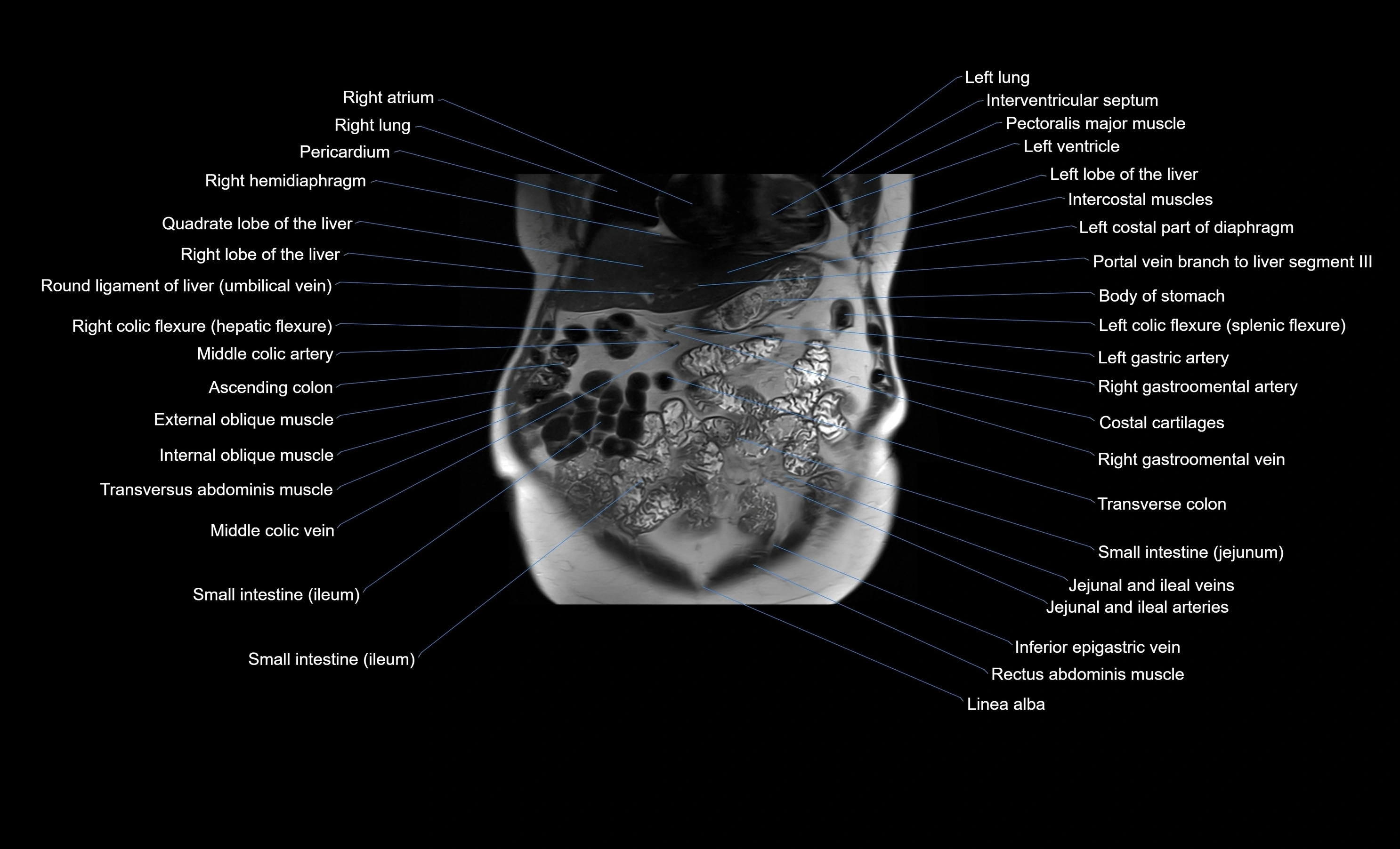 MRI Abdomen coronal labelled cross sectional anatomy radiology  image-img-00001-00016.webp